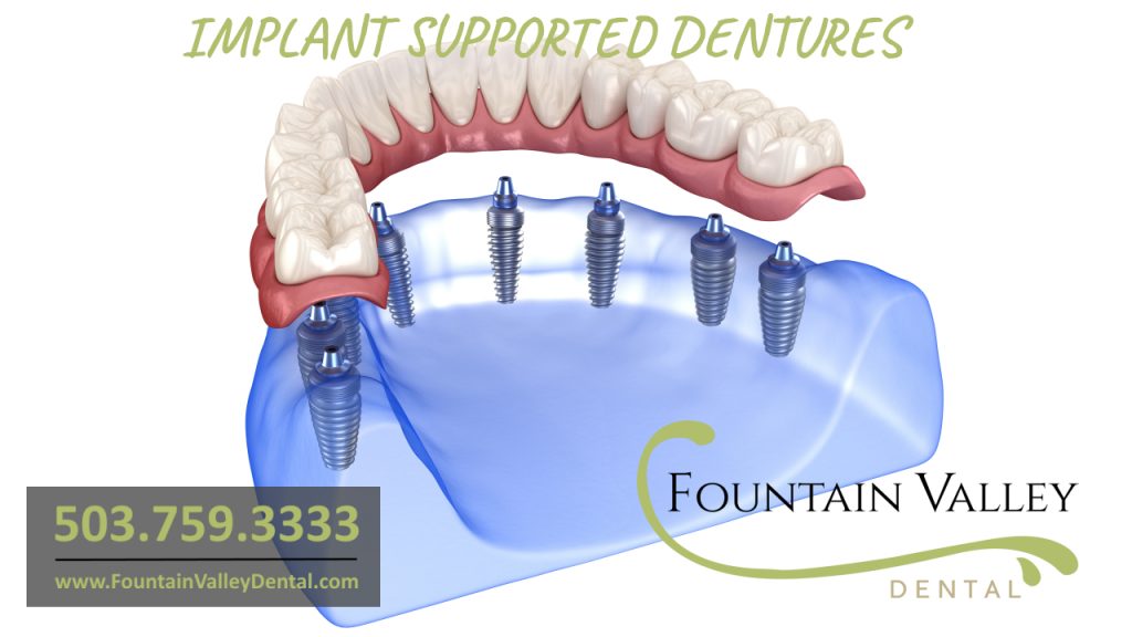 Implant Supported Dentures at Fountain Valley Dental in Molalla. Oregon