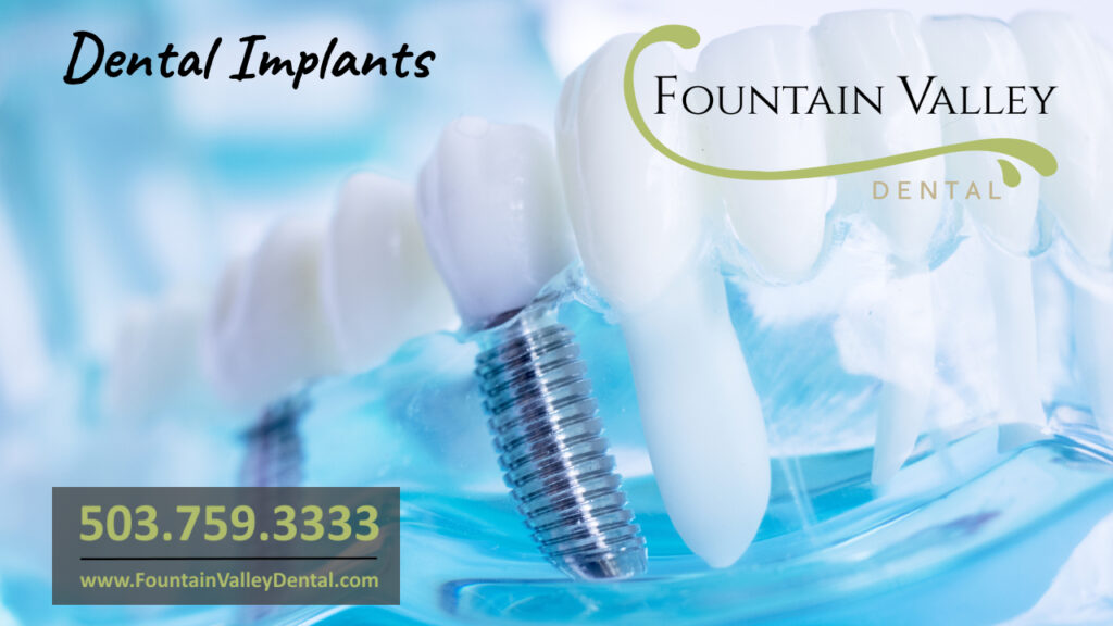 Dental Implants Dentists in Canby OR Restorative Implant Dentistry