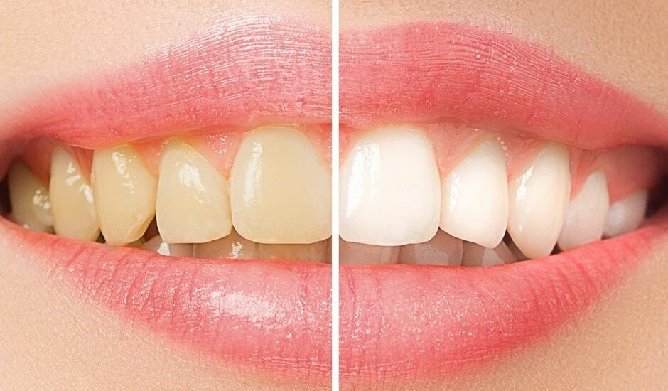 How Professional Whitening Differs from OTC