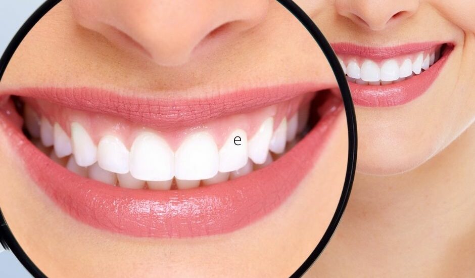 How Safe is Dental Teeth Whitening