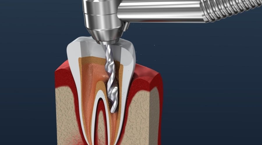 When Do I Need a Root Canal?