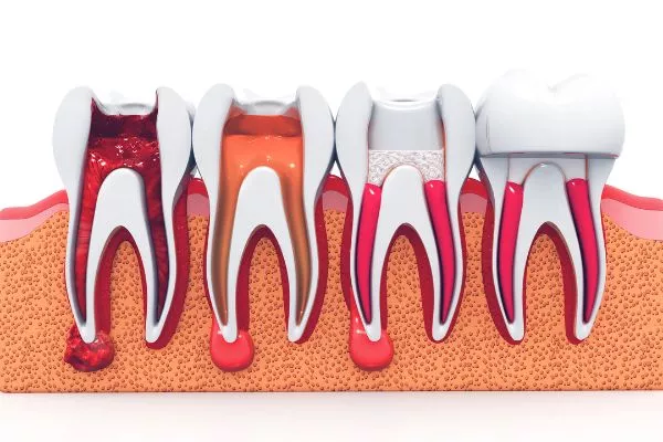 How a Cavity Turns Into a Root Canal