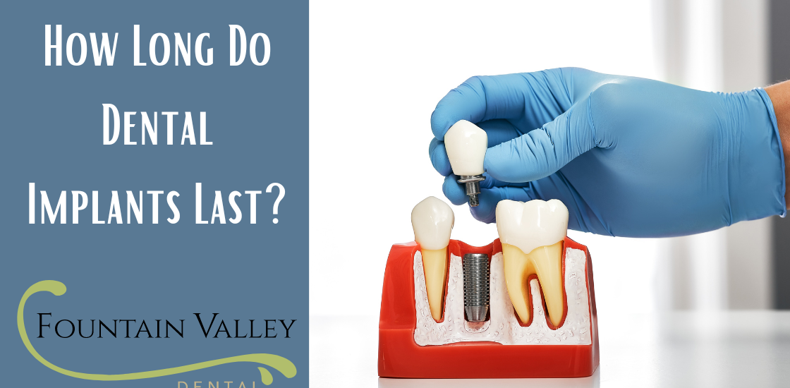 How Long Do Dental Implants Last