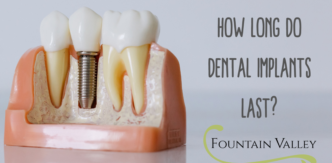 How Long Do Dental Implants Last?