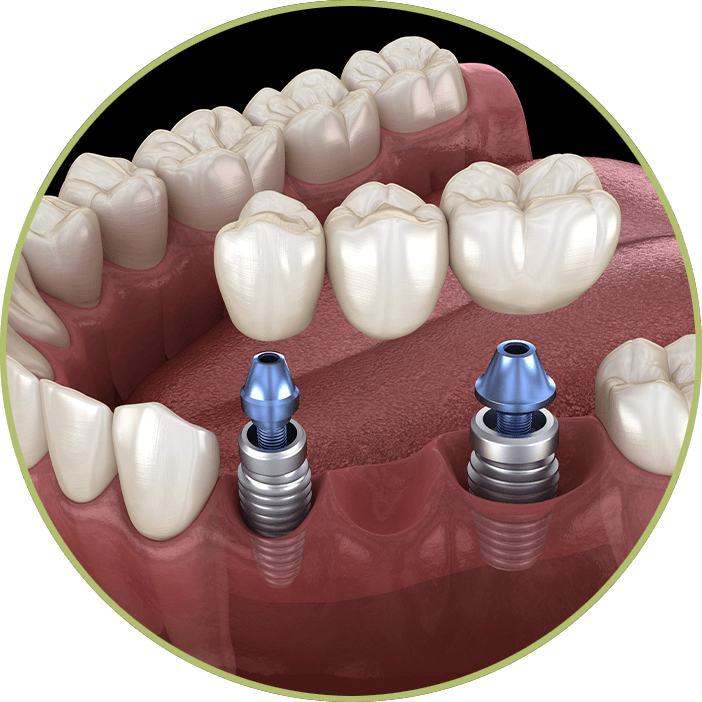 dental bridge