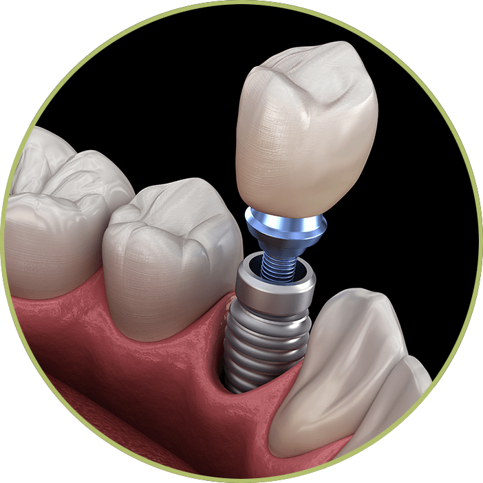 dental implants