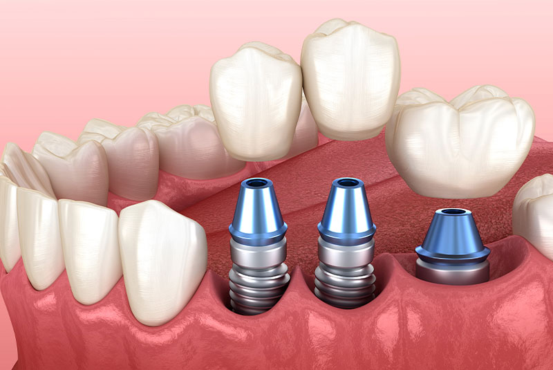 dental implants