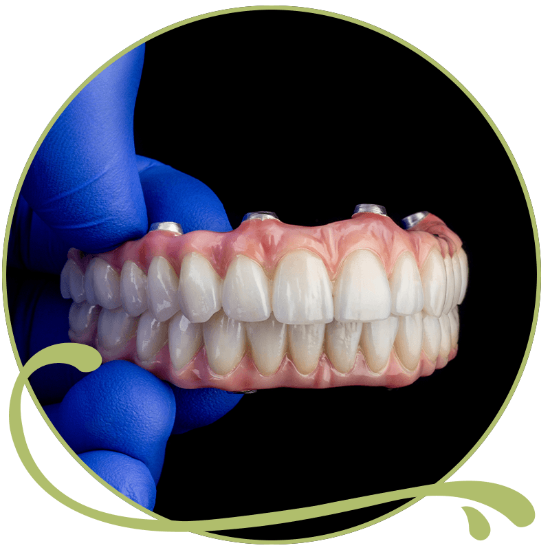 full arch dental implant model