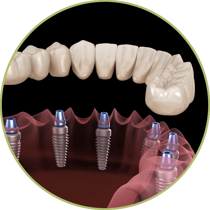 full mouth graphic