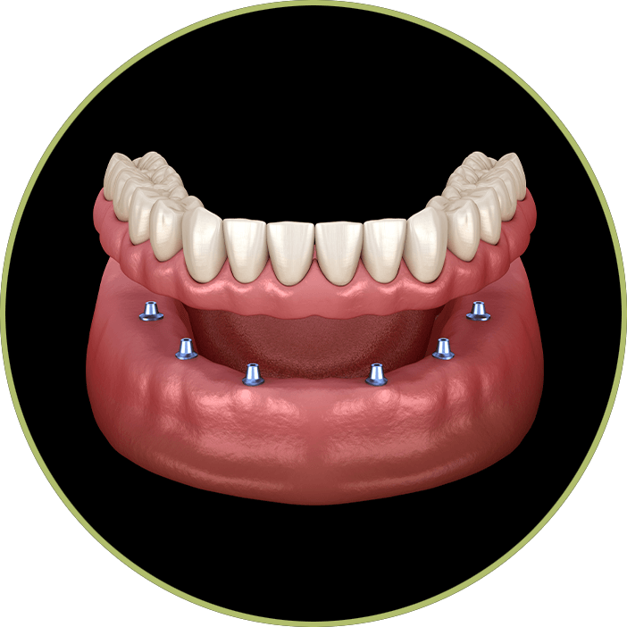 implant supported