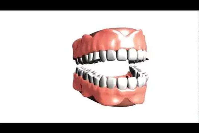 mv dentures thumbnail